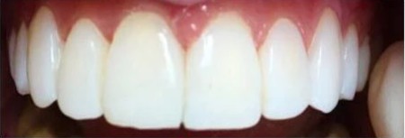 White Hygiene Teeth