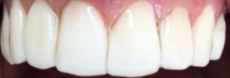 White Healthy Teeth